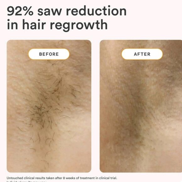 Nood The Flasher 2.0 IPL Permanent Hair Removal Device - Picture 4 of 12